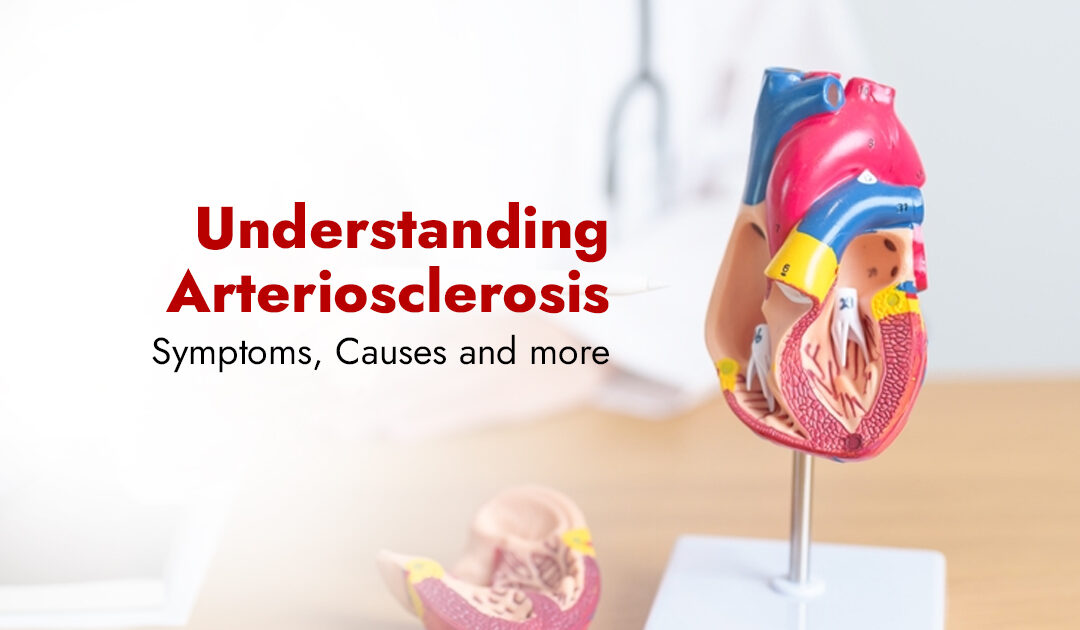 Understanding Arteriosclerosis – Symptoms, Causes and more